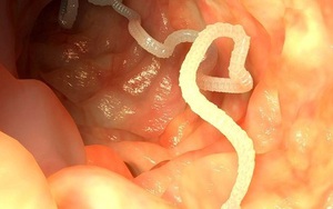 Do ăn uống thiếu vệ sinh, 6 con giun lạ sống ký sinh trong phổi