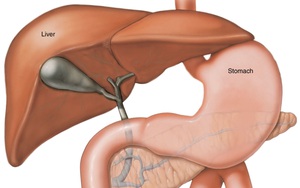 Ung thư gan giai đoạn cuối vì nhầm tưởng đau dạ dày