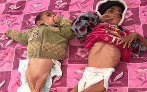 Hình ảnh 2 em bé da bọc xương chờ chết vì đói tại Iraq ám ảnh cả thế giới