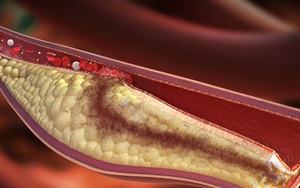 Cholesterol cao rất nguy hiểm, đây là 10 lời khuyên giúp bạn phòng tránh