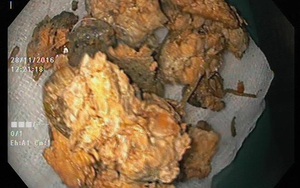 Nguy hiểm tính mạng do ăn một loại quả khi đói: Từ trẻ nhỏ đến người lớn đều phải cẩn thận