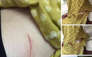 Hà Nội: Cô gái trẻ bị rạch đùi, cướp túi xách ngay giữa ban ngày?