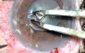 Kinh hãi: Video lấy con giun dài 14mm ra khỏi mắt người