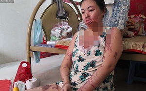 “Người mẹ ma” ở TP HCM: 'Ước gì tôi biết vì sao mình bị tạt axit'