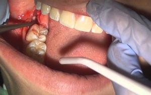 Khi nhổ răng hãy đề phòng những biến chứng gây nguy hiểm tính mạng