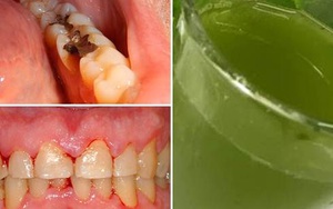 Nước lá chanh cô đặc: Bài thuốc chữa đau răng, viêm lợi hiệu quả