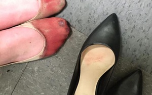 Nữ phục vụ bàn chia sẻ đôi chân rướm máu sau một ngày làm việc trên giày cao gót