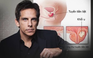 "Vua hài" Ben Stiller và cuộc chiến với ung thư tuyến tiền liệt