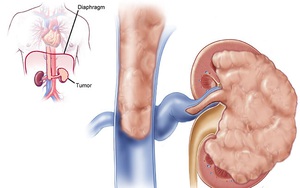 6 loại thực phẩm cực tốt cho thận mà giá rẻ không ngờ