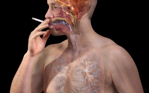 Mới 30 tuổi đã bị nhồi máu cơ tim: Hồi chuông báo động người hút thuốc lá