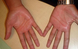 Mẹo dân gian trị bệnh ra mồ hôi chân tay cực hiệu quả