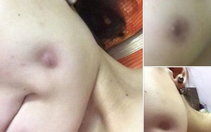 Giấu nhà đi phẫu thuật má lúm, cô gái trẻ "ôm hận" thiên thu