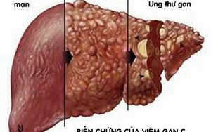 Những đối tượng có nguy cơ mắc bệnh viêm gan C cao nhất