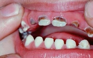 Xylitol có phải là “thần dược” ngừa sâu răng?