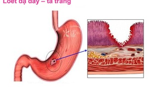 25 năm đau dạ dày hành hạ, người phụ nữ Yên Bái đã tìm được 1 phương pháp kỳ diệu