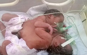 Hai bé song sinh dính liền ở Hà Giang: Khó phẫu thuật tách rời