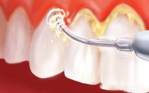 Cao răng phá huỷ sức khỏe răng miệng thế nào?