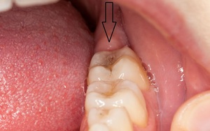 Bật mí 7 cách giúp chữa đau răng khôn hiệu quả