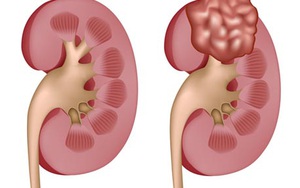 Dấu hiệu cảnh báo sớm của 1 loại ung thư rất khó phát hiện: Nếu bạn cũng có phải khám ngay