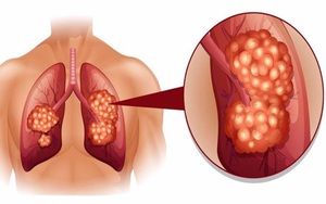 Thấy 1 trong 8 triệu chứng báo trước ung thư phổi, hãy đi khám ngay trước khi quá muộn!