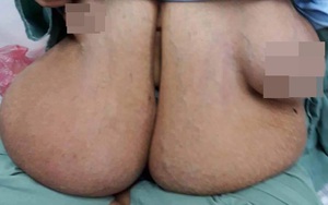 Người đàn bà có bộ ngực lớn bất thường ở VN: "Tôi khổ lắm, chẳng làm được gì vì ngực nặng"