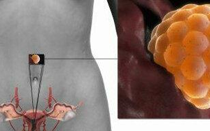 Bị cuốn hút bởi đề nghị bán trứng với giá hời, cô gái 17 tuổi hối không kịp