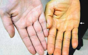 Bác sĩ cảnh báo: Phát hiện những dấu hiệu sau, ung thư gan đã ở giai đoạn muộn