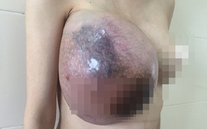 Vừa sinh con xong, người mẹ trẻ ở Hà Nội phải cắt bỏ một bên vú vì u Phyllode khổng lồ