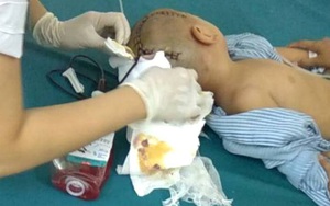 Bé trai gần 4 tuổi não bị tụ máu khi đi học ở trường mầm non
