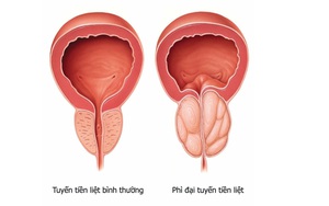 Căn bệnh để lâu có thể dẫn đến suy thận: Chuyên gia chỉ dấu hiệu cần đi khám ngay