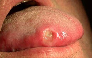 Chuyên gia chỉ dấu hiệu ung thư nguy hiểm ở miệng: Người lười vệ sinh răng miệng cần chú ý