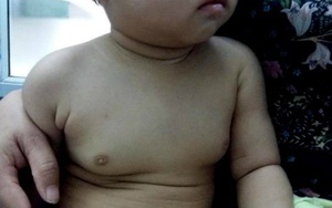 Bé gái 2 tuổi ngực to như 18 tuổi vì "ăn thuốc tránh thai" của mẹ