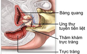 Căn bệnh này là nguyên nhân dẫn đến vô sinh: 7 lời chuyên gia khuyên để phòng bệnh