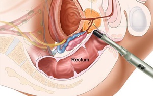 Căn bệnh ung thư mà cứ 7 đàn ông có 1 người mắc: 5 dấu hiệu cảnh báo rõ ràng nhất