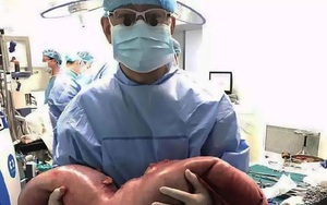 Mổ bụng bệnh nhân, bác sĩ tá hỏa khi phát hiện khối đại tràng dài 76cm do bị táo bón nhiều năm