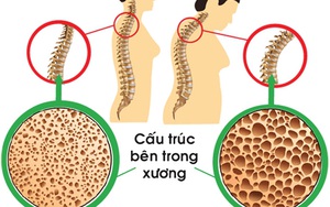 Tuổi 'bẻ gãy sừng trâu' cũng… liệt giường vì loãng xương