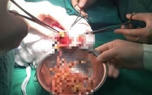 Bị đau bụng 6 ngày không khỏi, bác sĩ lôi ra túi giun lớn từ bụng bé gái 3 tuổi