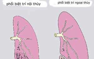 Nội soi thành công ca dị tật phổi hiếm gặp
