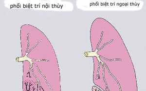 Nội soi thành công ca dị tật phổi hiếm gặp