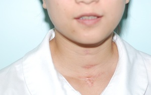 Nhiễm virus HPV, sinh viên 23 năm mang ống thông ngay cổ