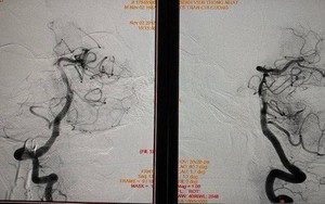 "Lôi" được cục máu đông gây đột quỵ dài nhất Việt Nam