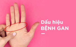 Một điểm trên bàn tay bị đỏ: Dấu hiệu cảnh báo bệnh gan không thể xem nhẹ
