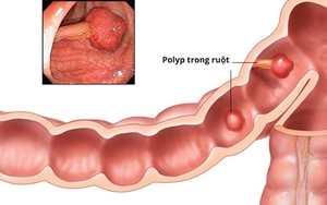 Biến chứng của bệnh polyp đại tràng