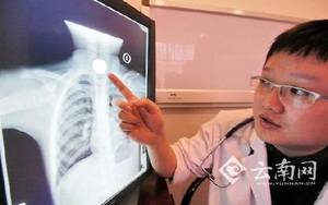 Bé gái 3 tuổi bị kẹt đồng xu trong thực quản suốt 20 giờ
