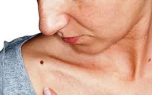 Nốt ruồi trên cơ thể: Khi nào cần lo lắng?