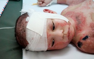 Cô bé 5 lần mổ ghép da kiên cường giành sự sống đã được về nhà
