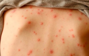 Cách phát hiện bệnh thủy đậu