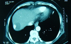 Loại bỏ khối u gan khổng lồ ở bệnh nhân nữ 67 tuổi