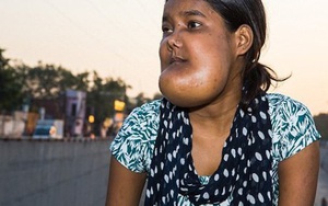 Ấn Độ: Căn bệnh quái ác khiến thiếu nữ mang khuôn mặt của "quỷ dữ" và bị cả xã hội ruồng bỏ
