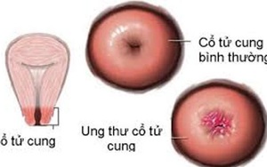 2.500 ca tử vong vì ung thư cổ tử cung mỗi năm tại Việt Nam